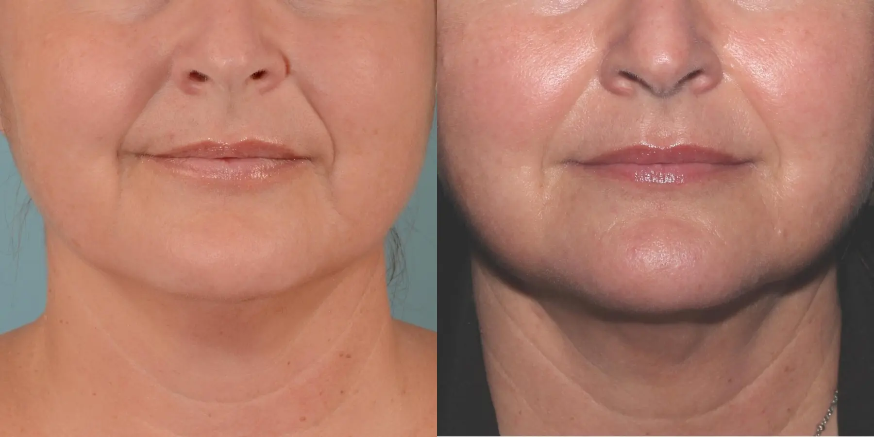 Skin Tightening Face: Patient 4 - Before and After 3