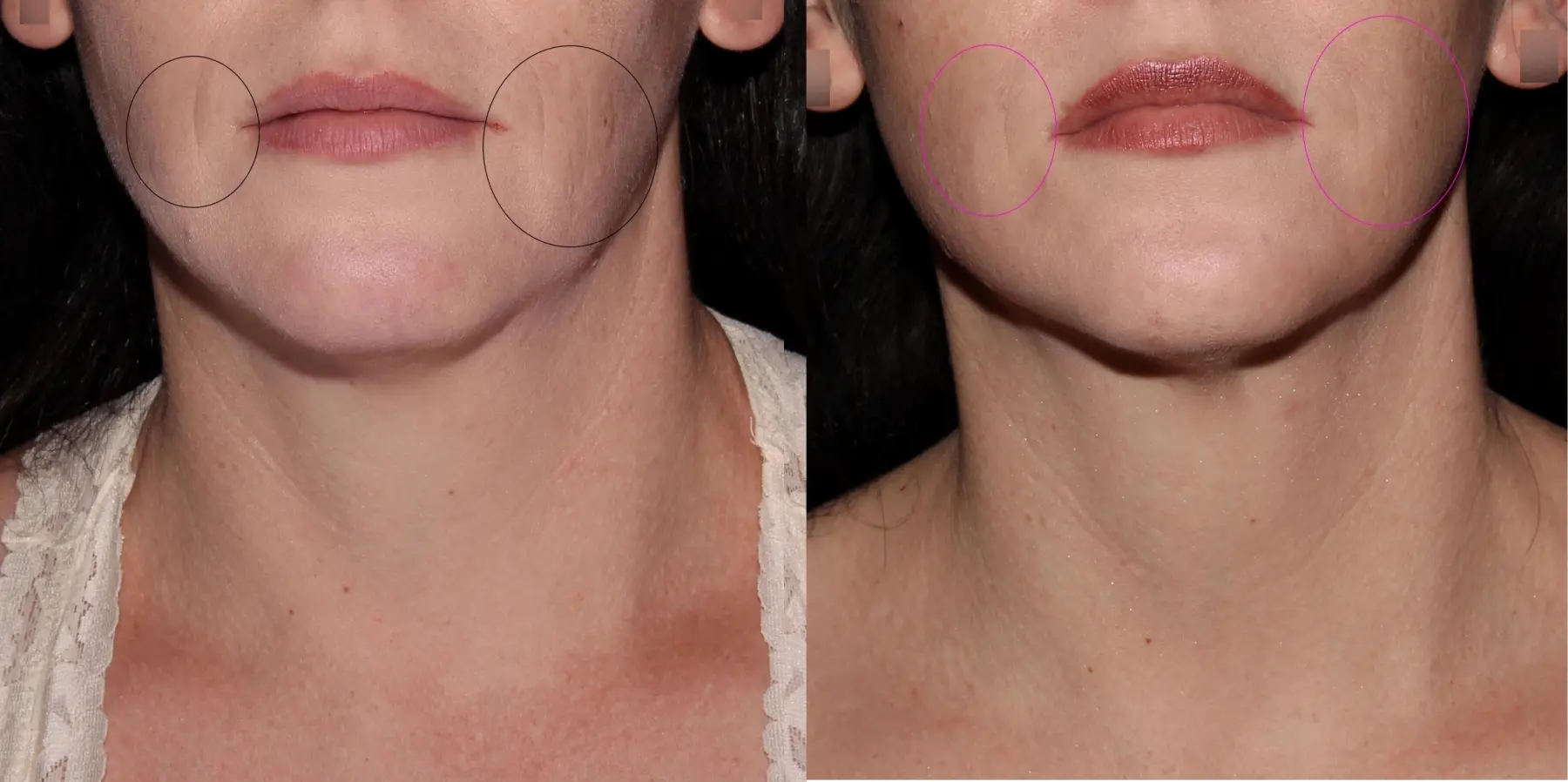 Skin Tightening Face: Patient 2 - Before and After 3