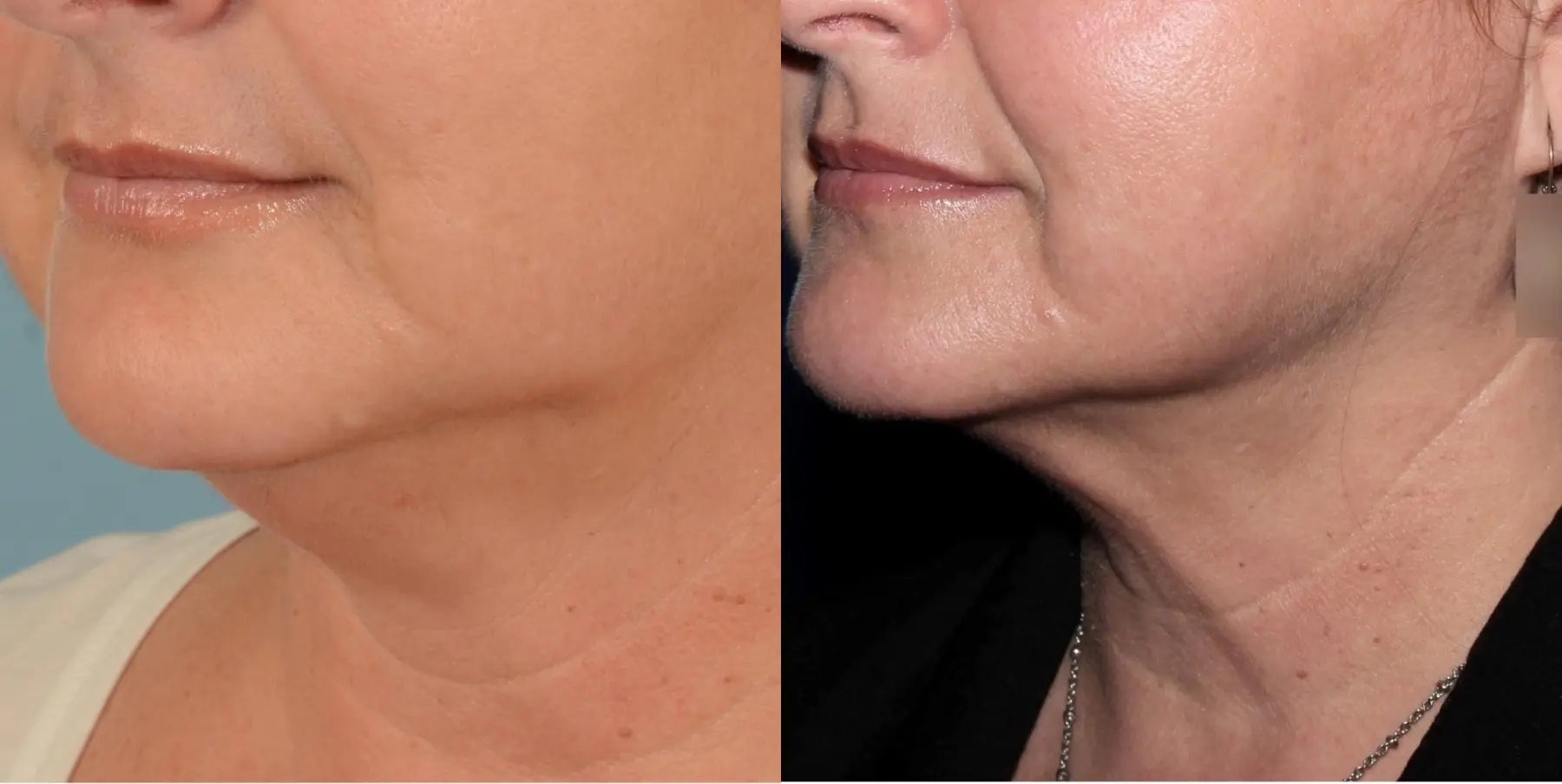 Skin Tightening Face: Patient 4 - Before and After 2