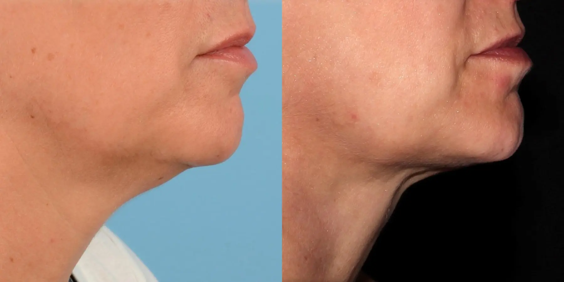 Skin Tightening Face: Patient 6 - Before and After 1