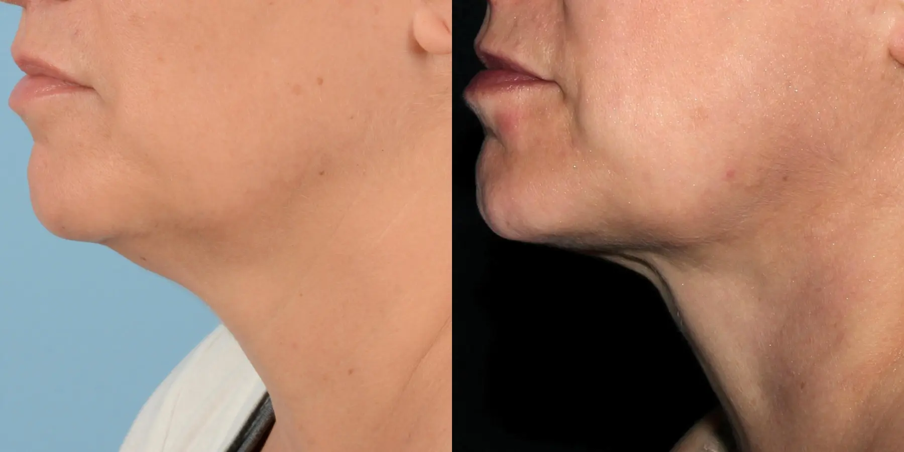 Skin Tightening Face: Patient 5 - Before and After  