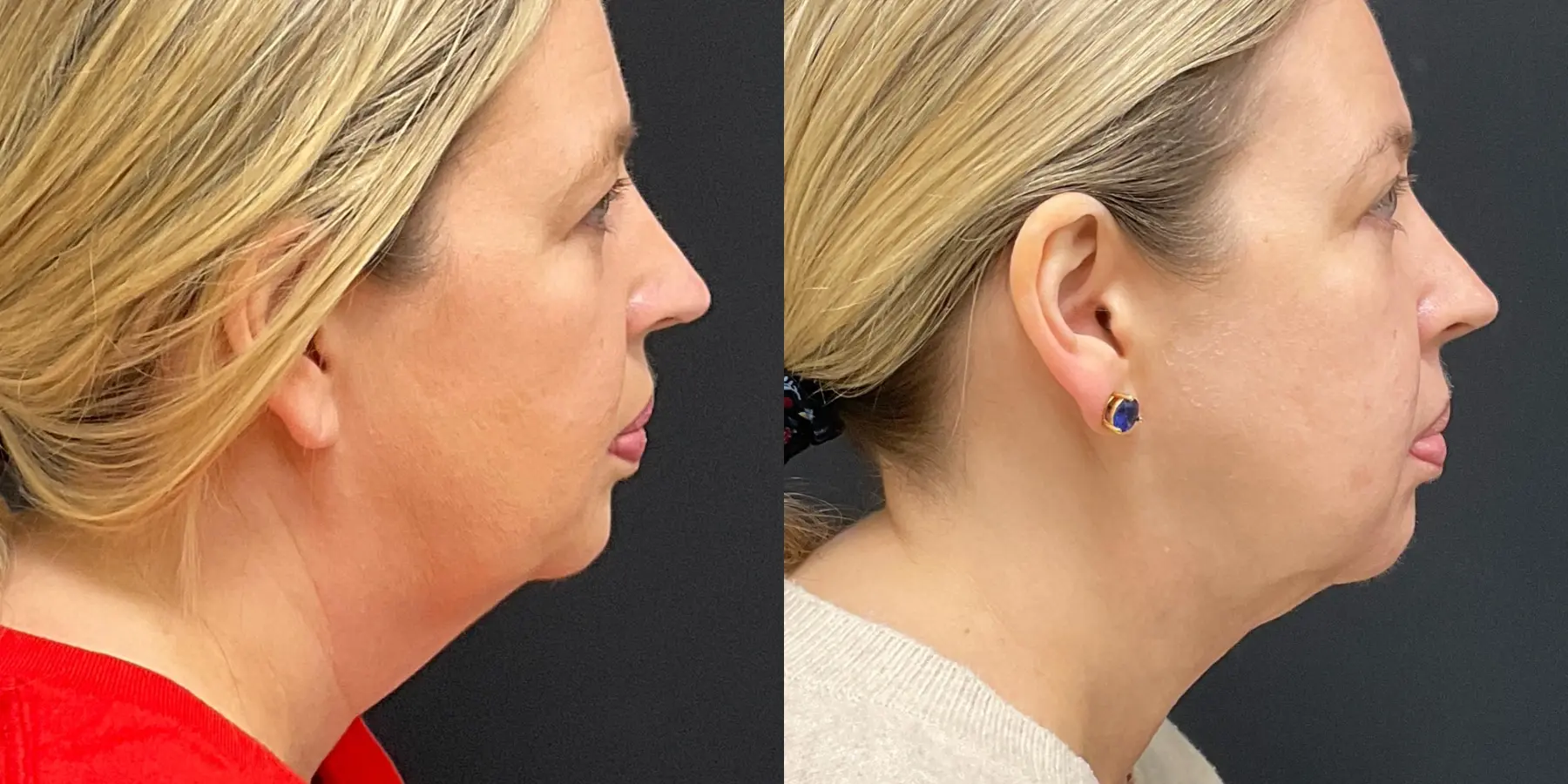 Skin Tightening Face: Patient 1 - Before and After  