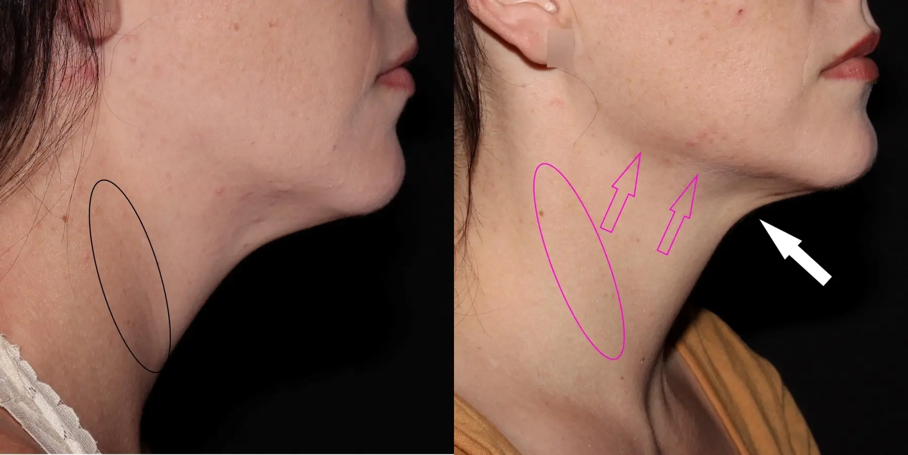 Skin Tightening Face: Patient 2 - Before and After 1