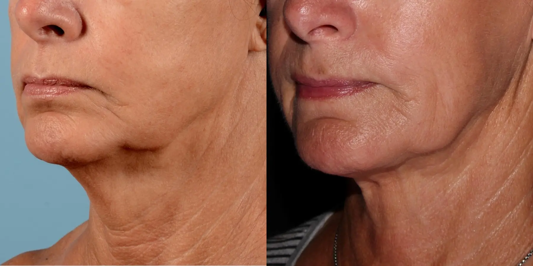 Skin Tightening Face: Patient 5 - Before and After 2