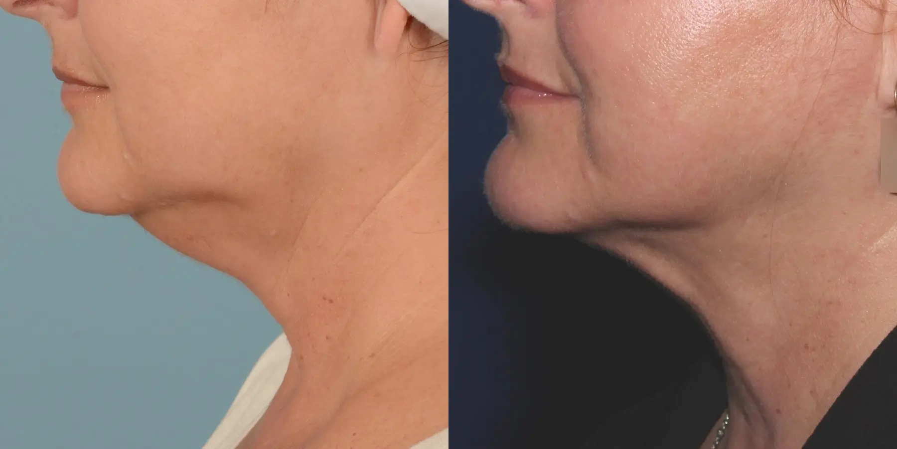 Skin Tightening Face: Patient 4 - Before and After 4