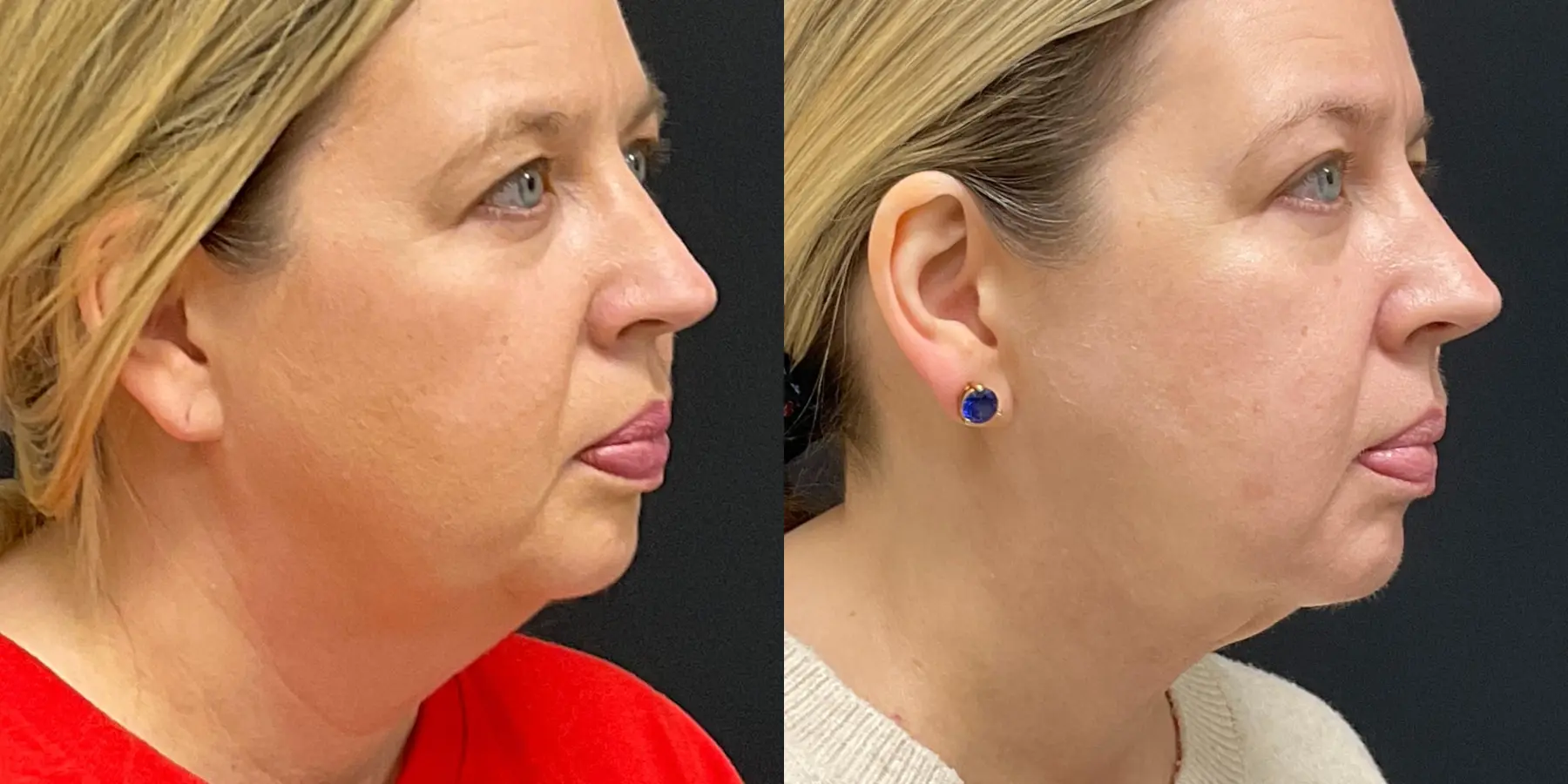 Skin Tightening Face: Patient 1 - Before and After 2