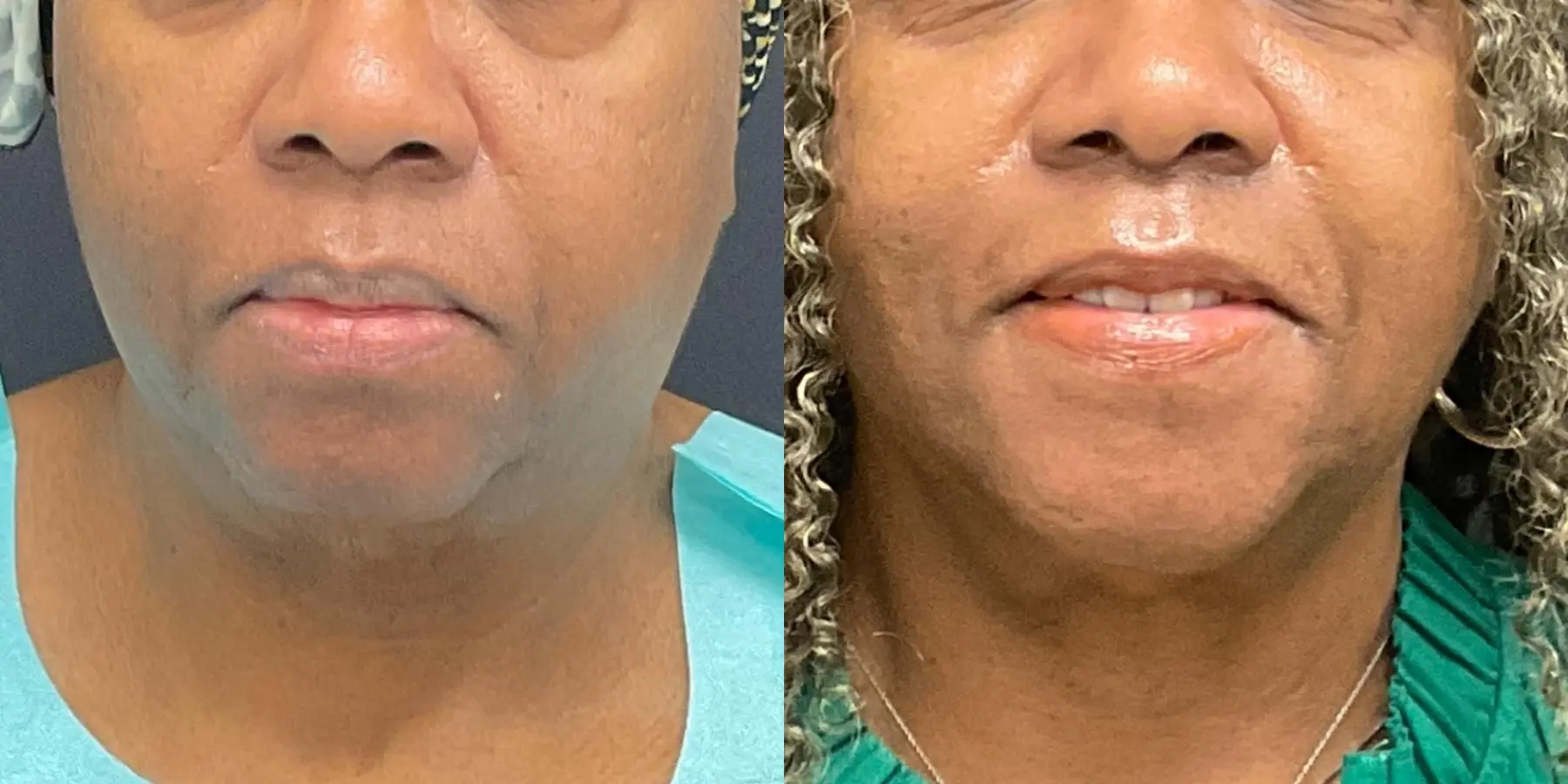 Skin Tightening Face: Patient 3 - Before and After  