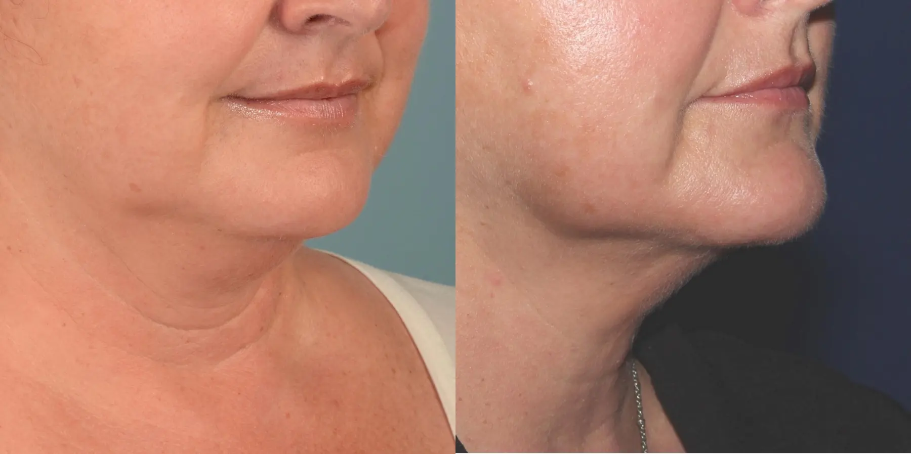 Skin Tightening Face: Patient 4 - Before and After  