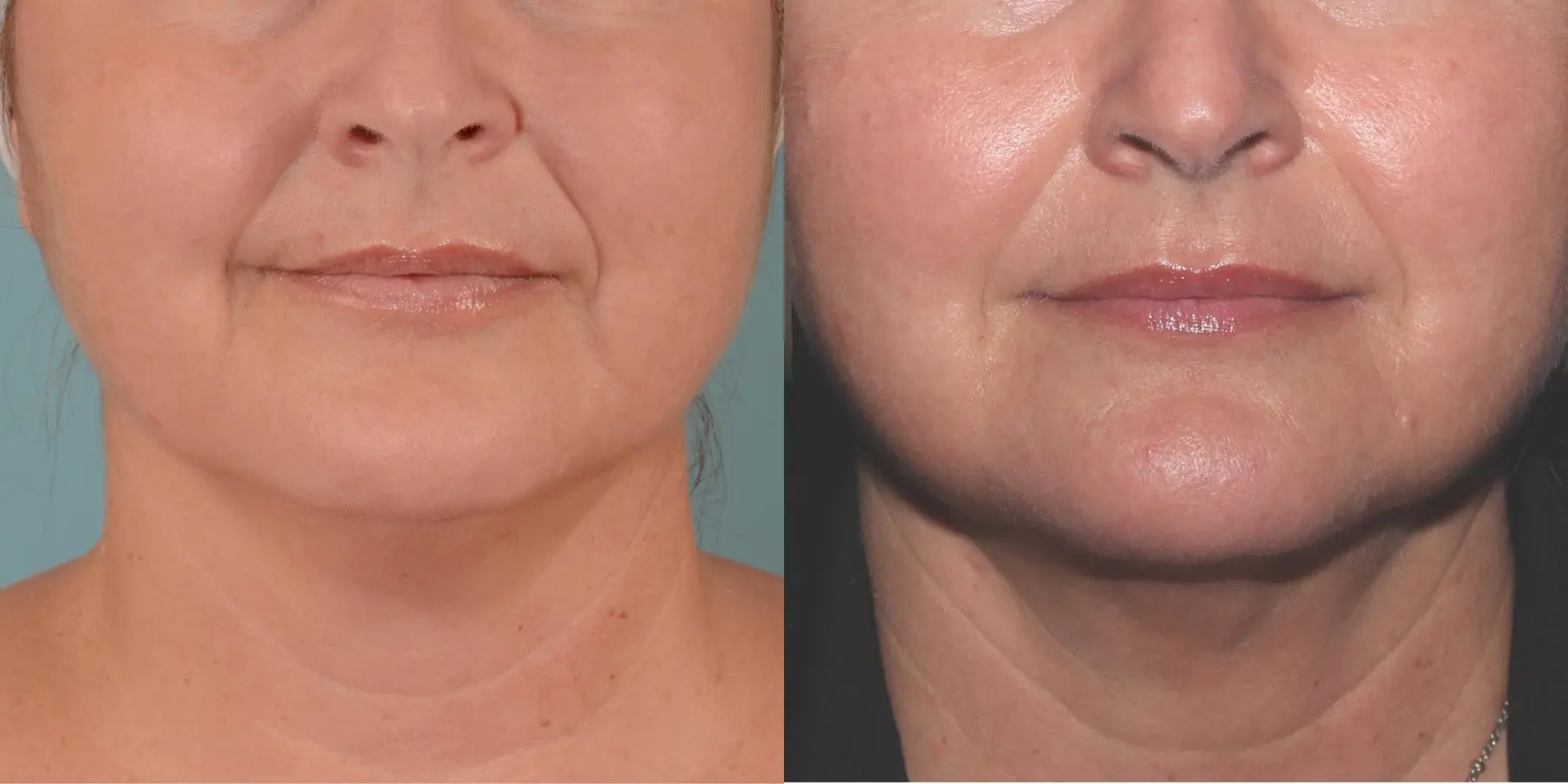 Skin Tightening Face: Patient 6 - Before and After  