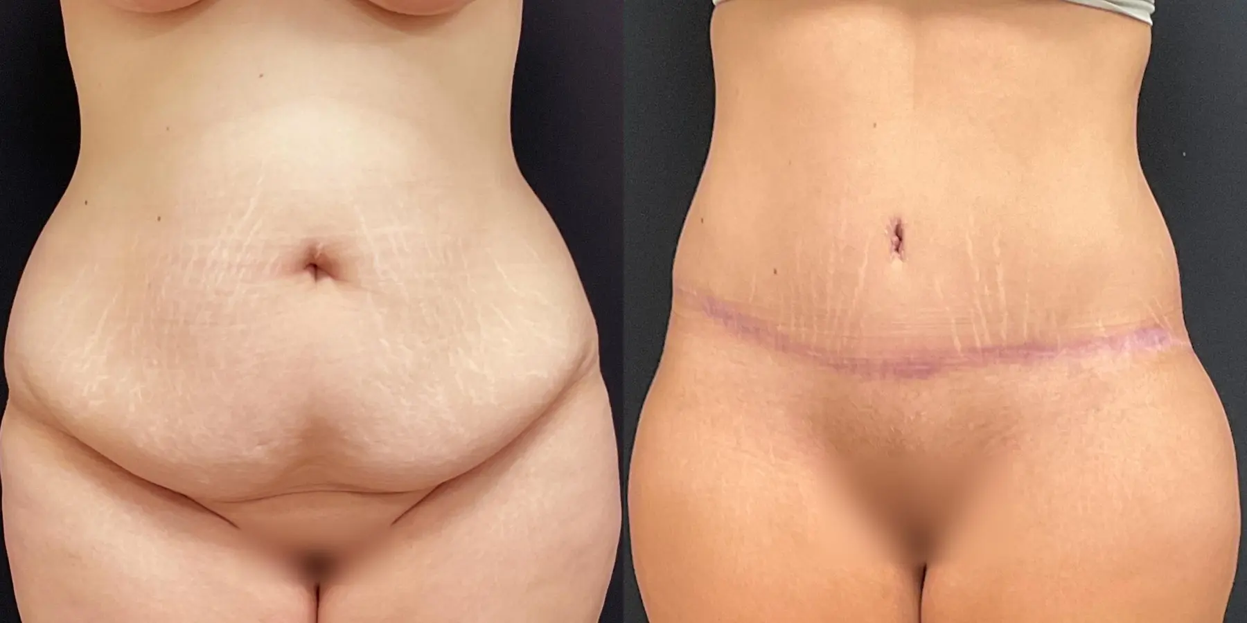 Tummy Tuck: Patient 11 - Before and After  