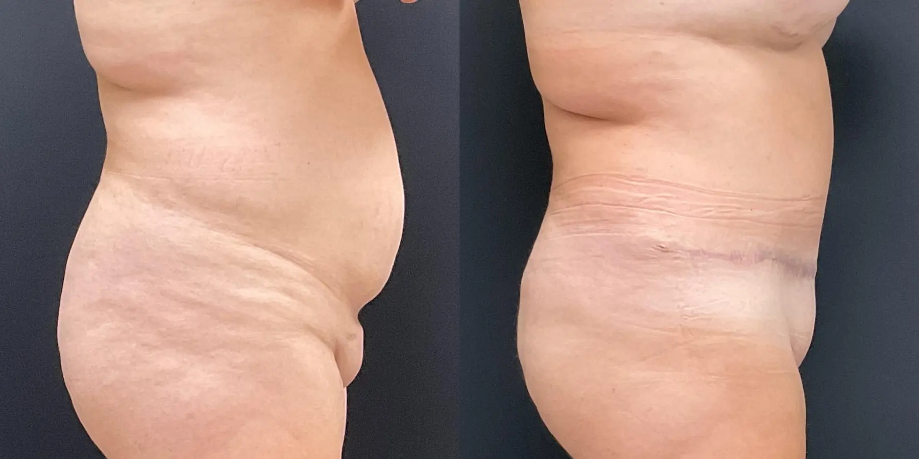 Tummy Tuck: Patient 16 - Before and After 5