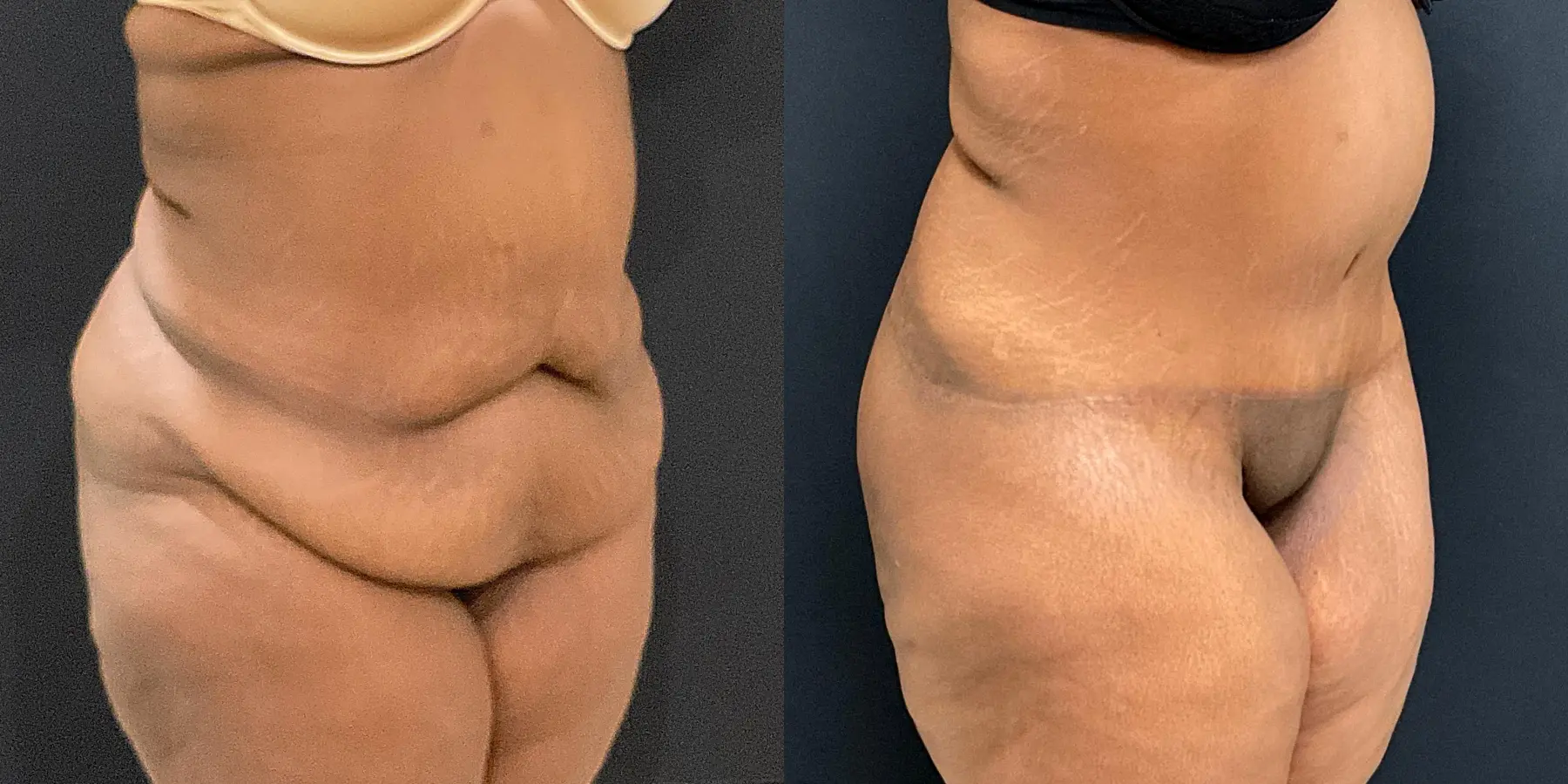 Tummy Tuck: Patient 3 - Before and After 2