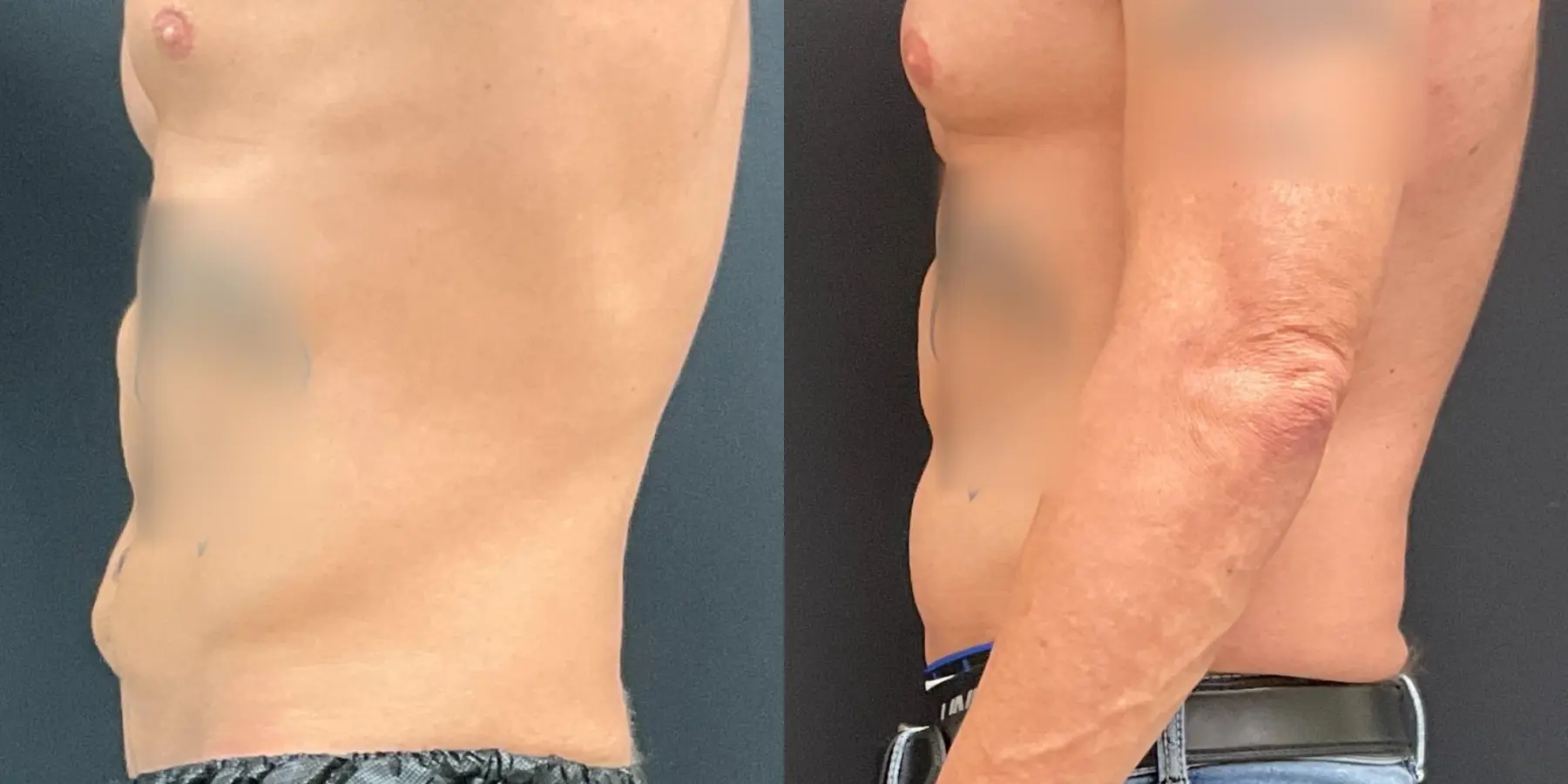 Tummy Tuck For Men: Patient 2 - Before and After 2