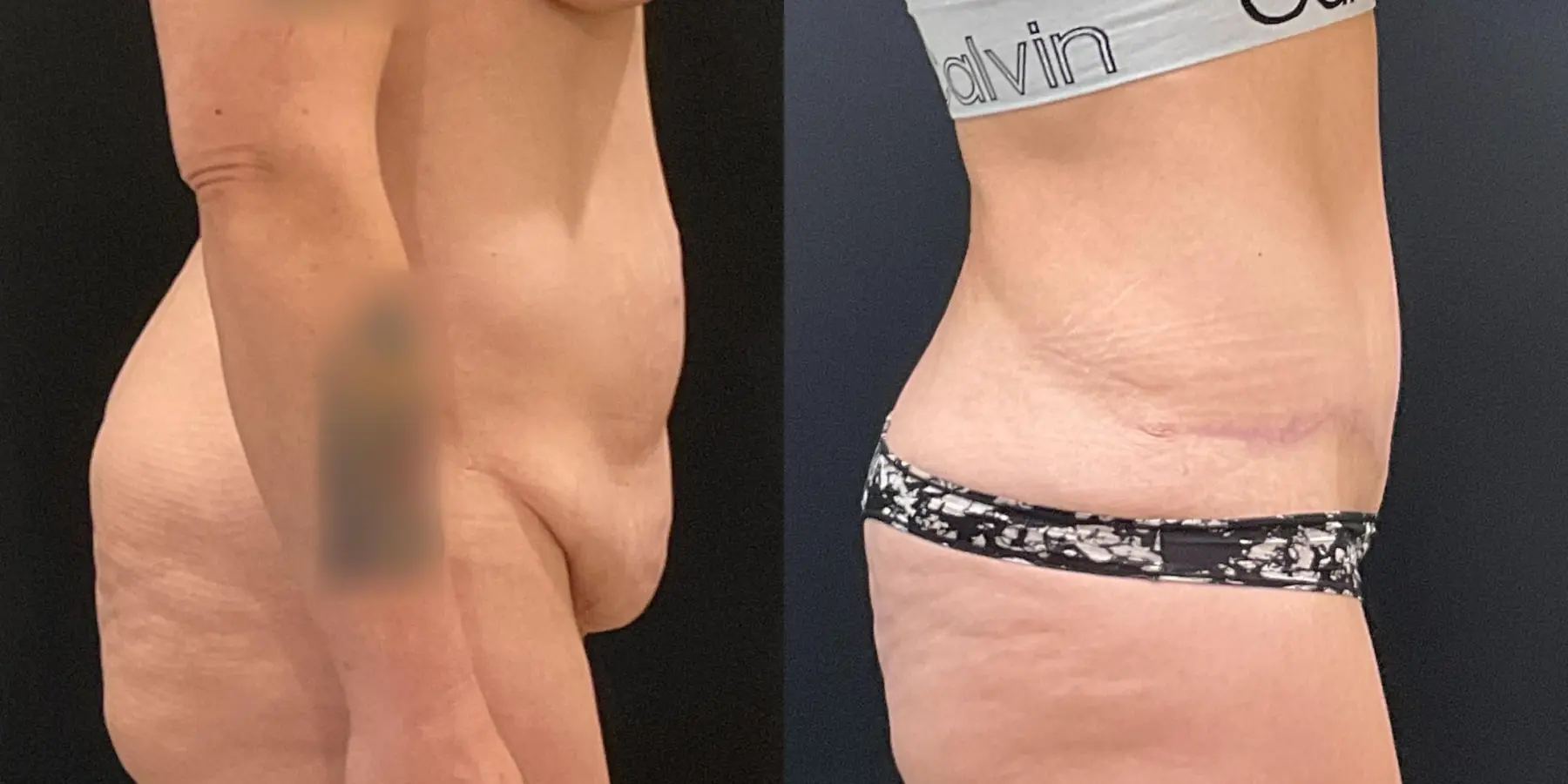 Tummy Tuck: Patient 15 - Before and After 5