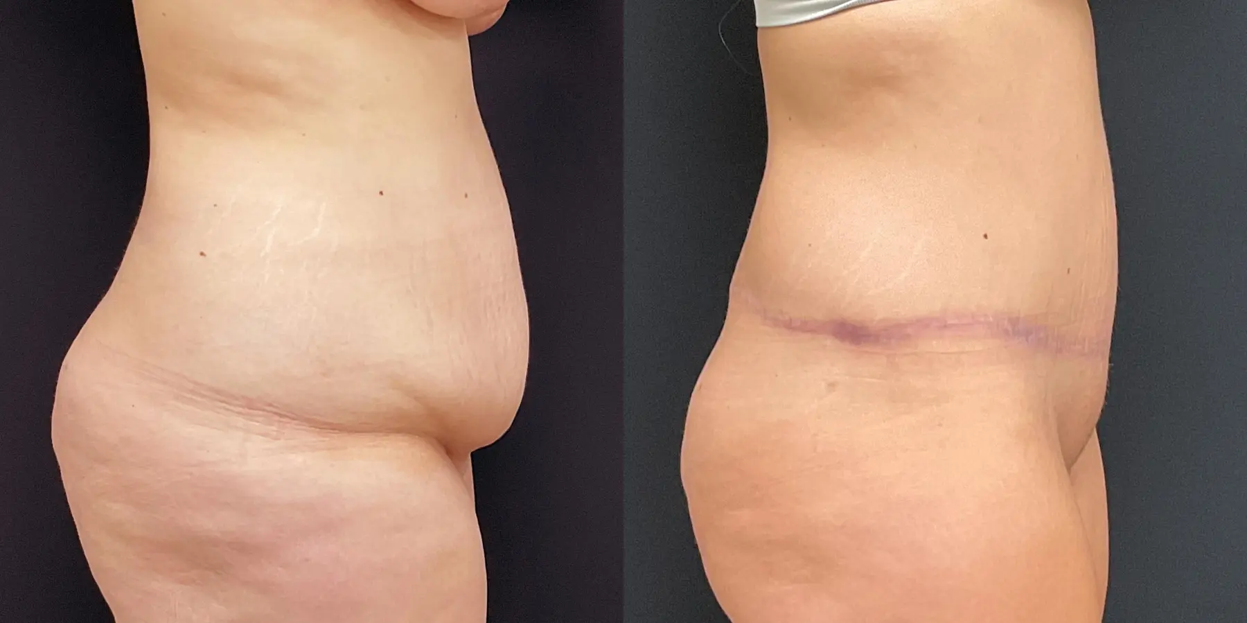 Tummy Tuck: Patient 2 - Before and After 5