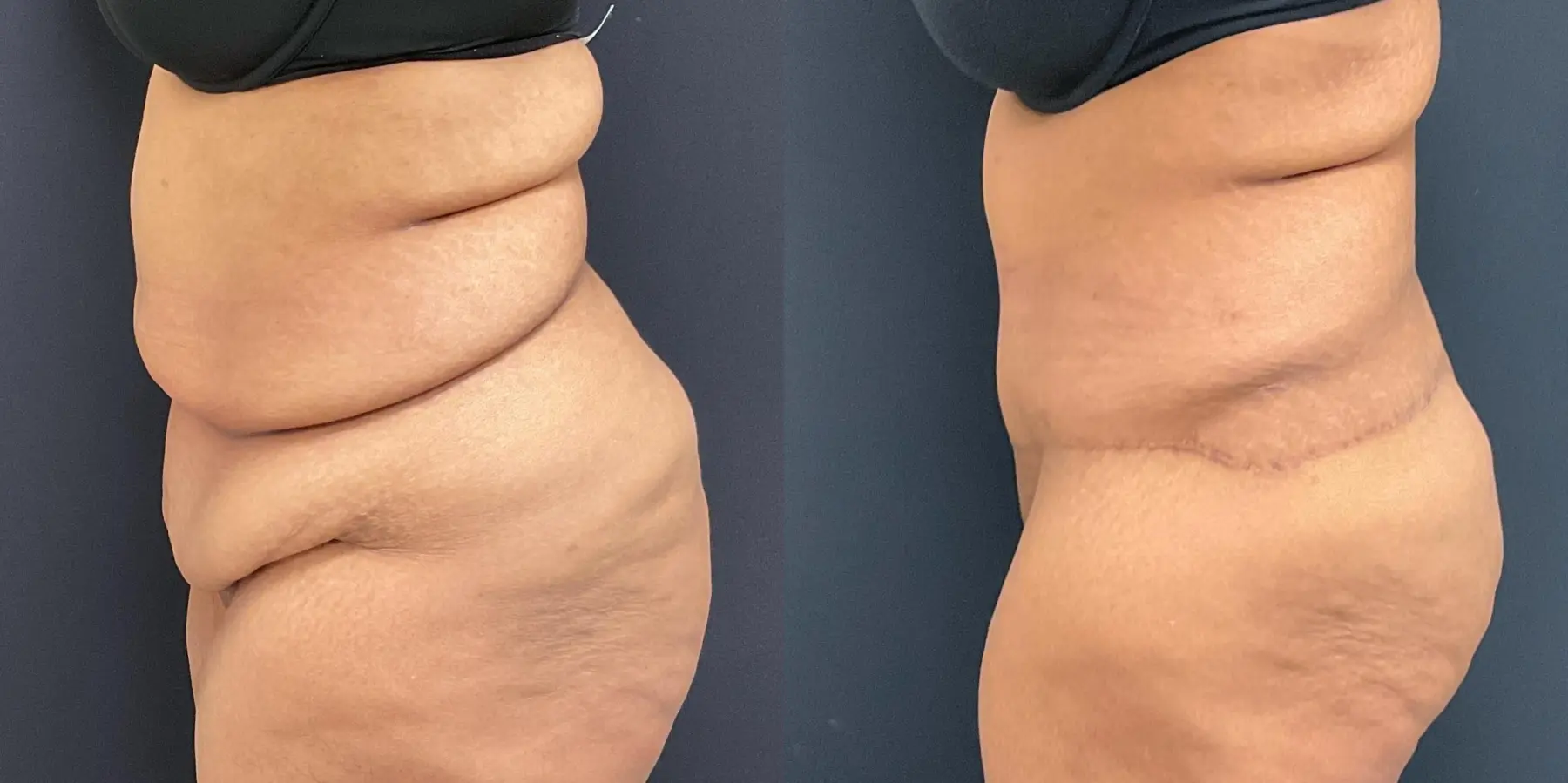 Tummy Tuck: Patient 10 - Before and After 4