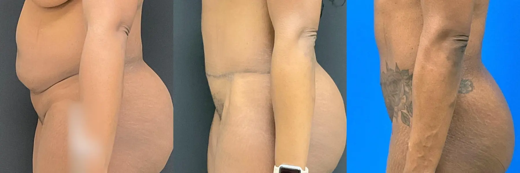 Tummy Tuck: Patient 19 - Before and After 4