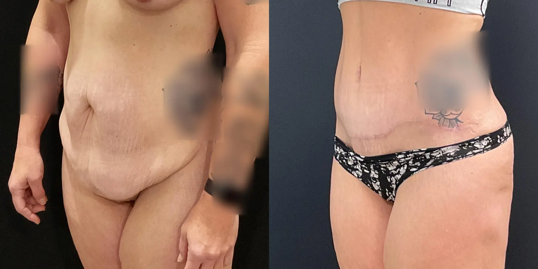 Tummy Tuck: Patient 15 - Before and After 2