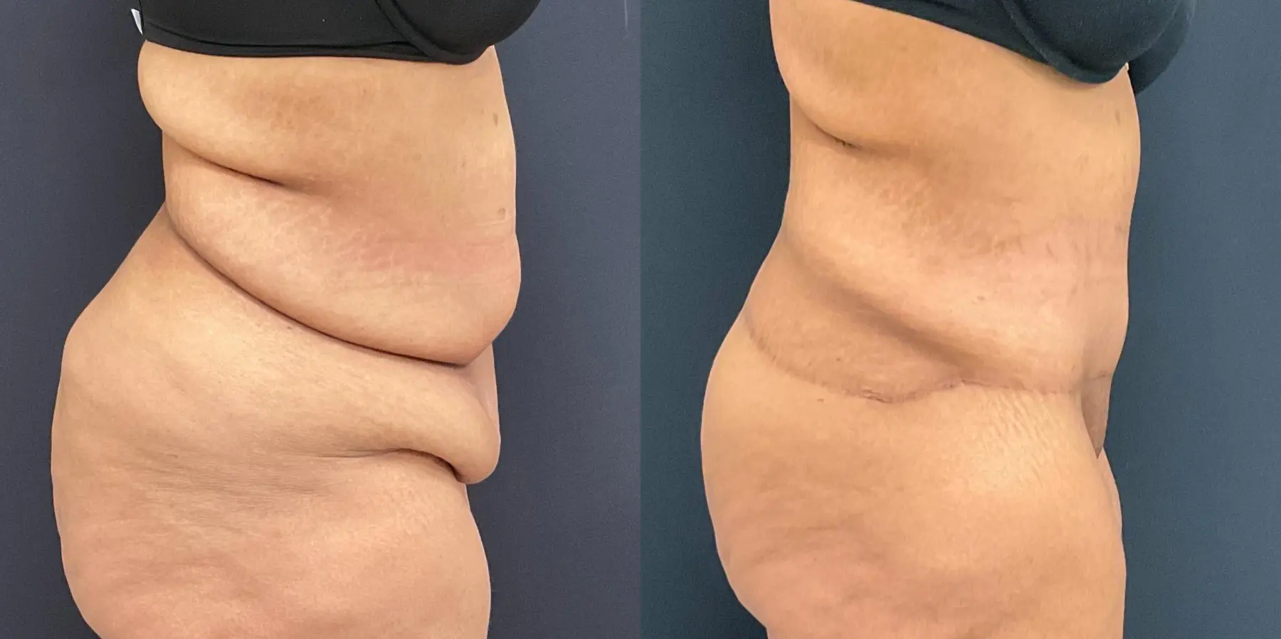 Tummy Tuck: Patient 10 - Before and After 5