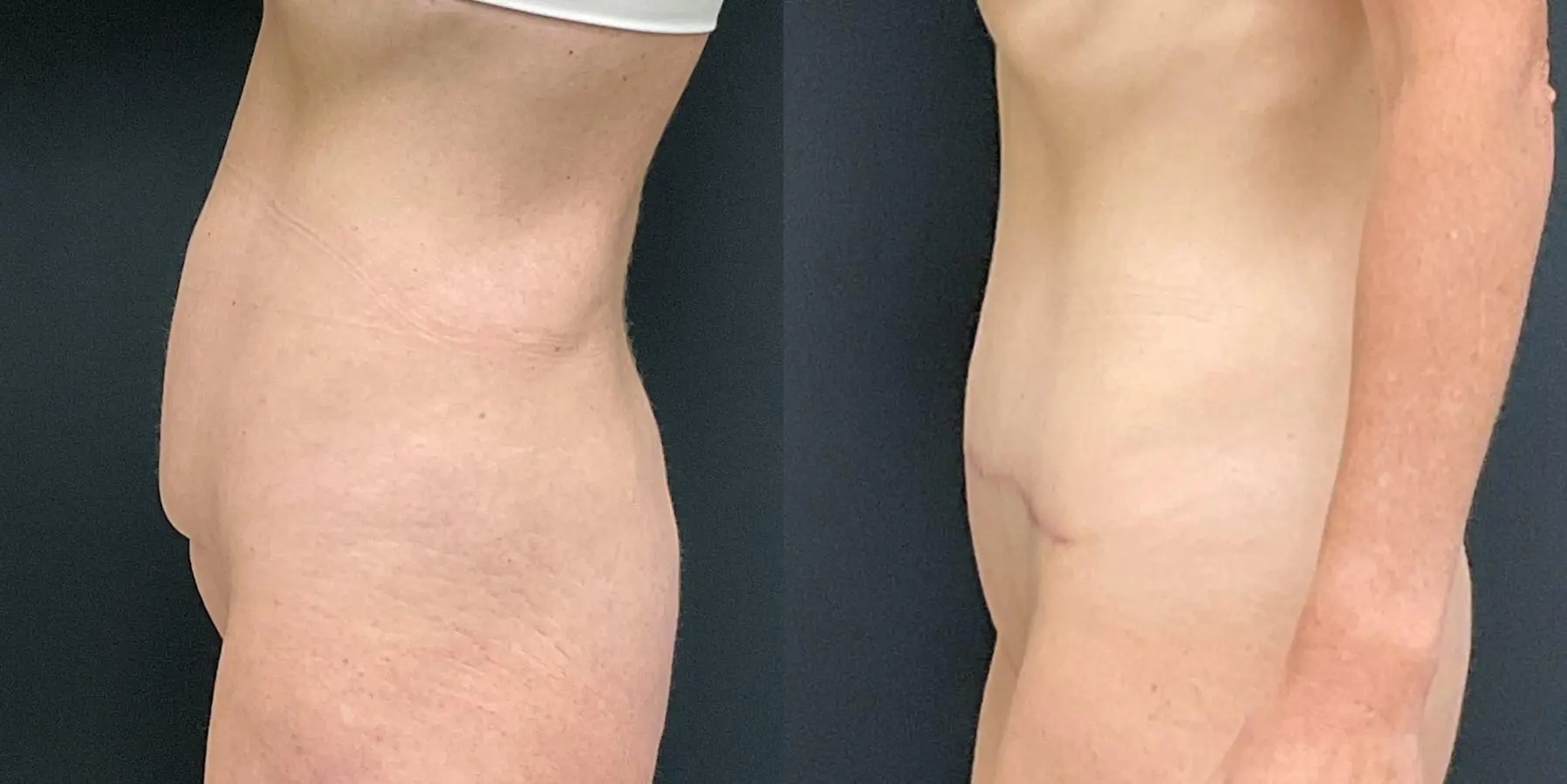 Tummy Tuck: Patient 13 - Before and After 4