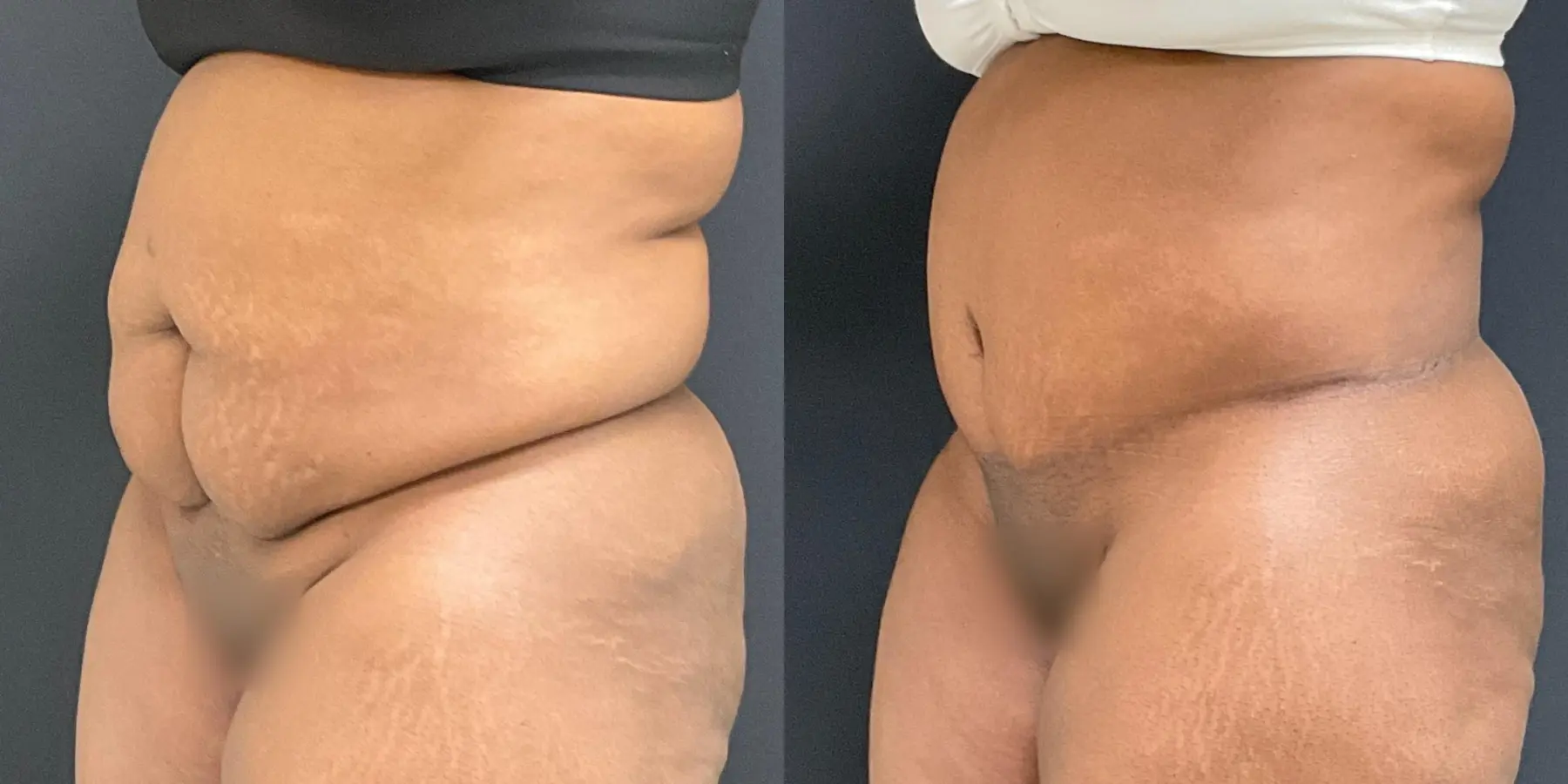 Tummy Tuck: Patient 18 - Before and After 2