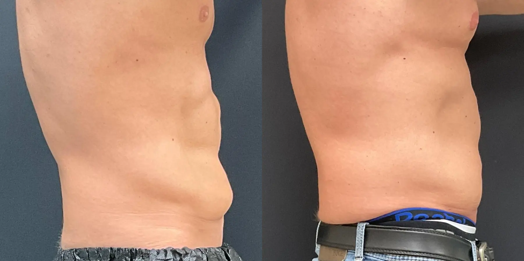 Tummy Tuck For Men: Patient 1 - Before and After 3