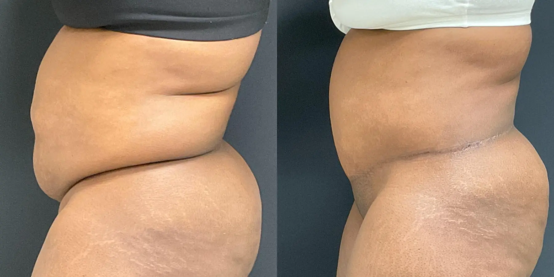 Tummy Tuck: Patient 18 - Before and After 4