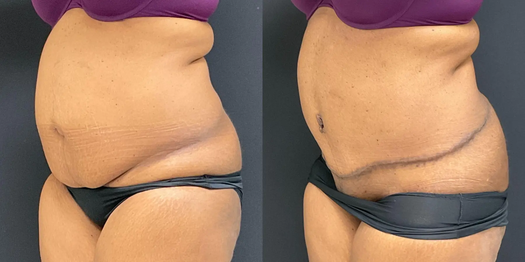 Tummy Tuck: Patient 5 - Before and After 2