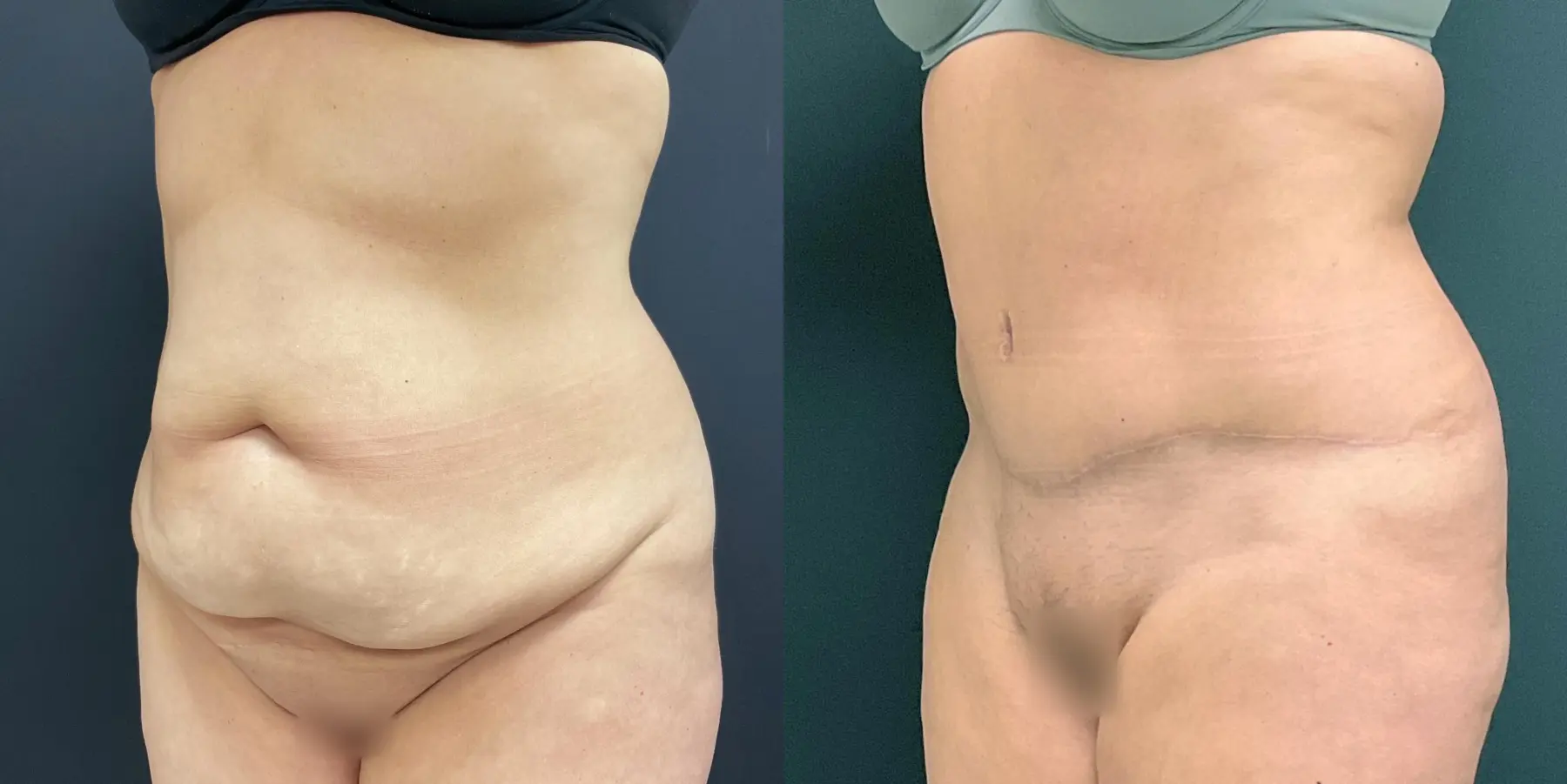 Tummy Tuck: Patient 21 - Before and After 2