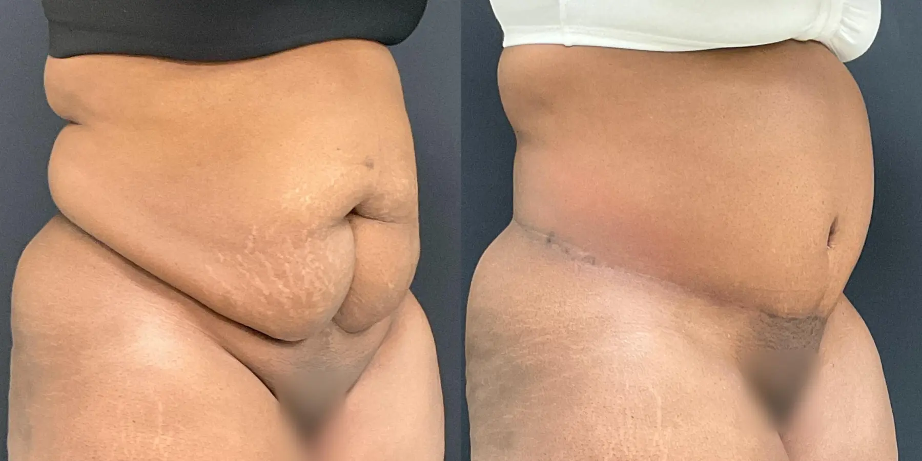 Tummy Tuck: Patient 18 - Before and After 3