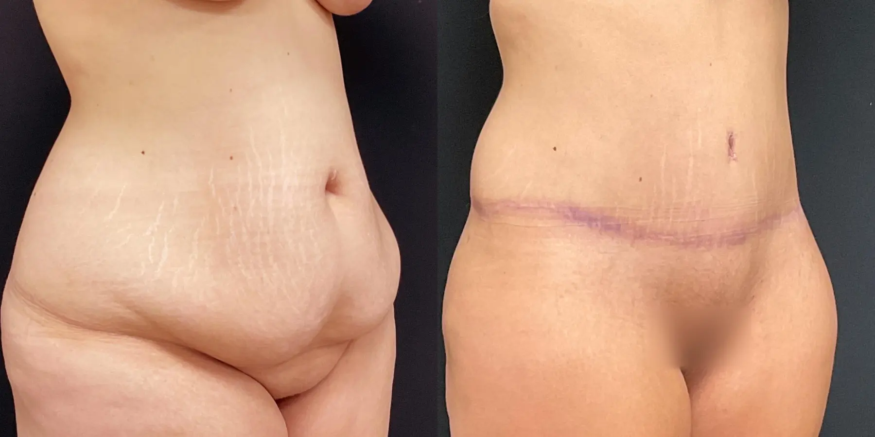 Tummy Tuck: Patient 2 - Before and After 3