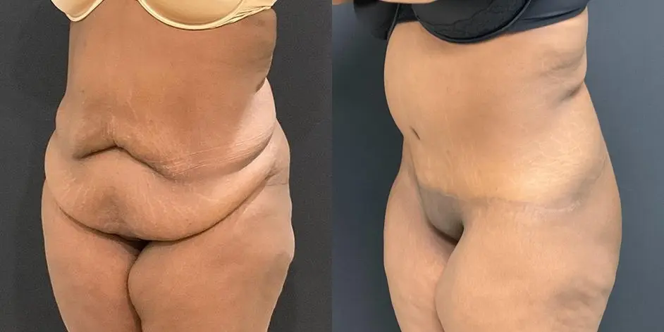 Tummy Tuck: Patient 3 - Before and After 3