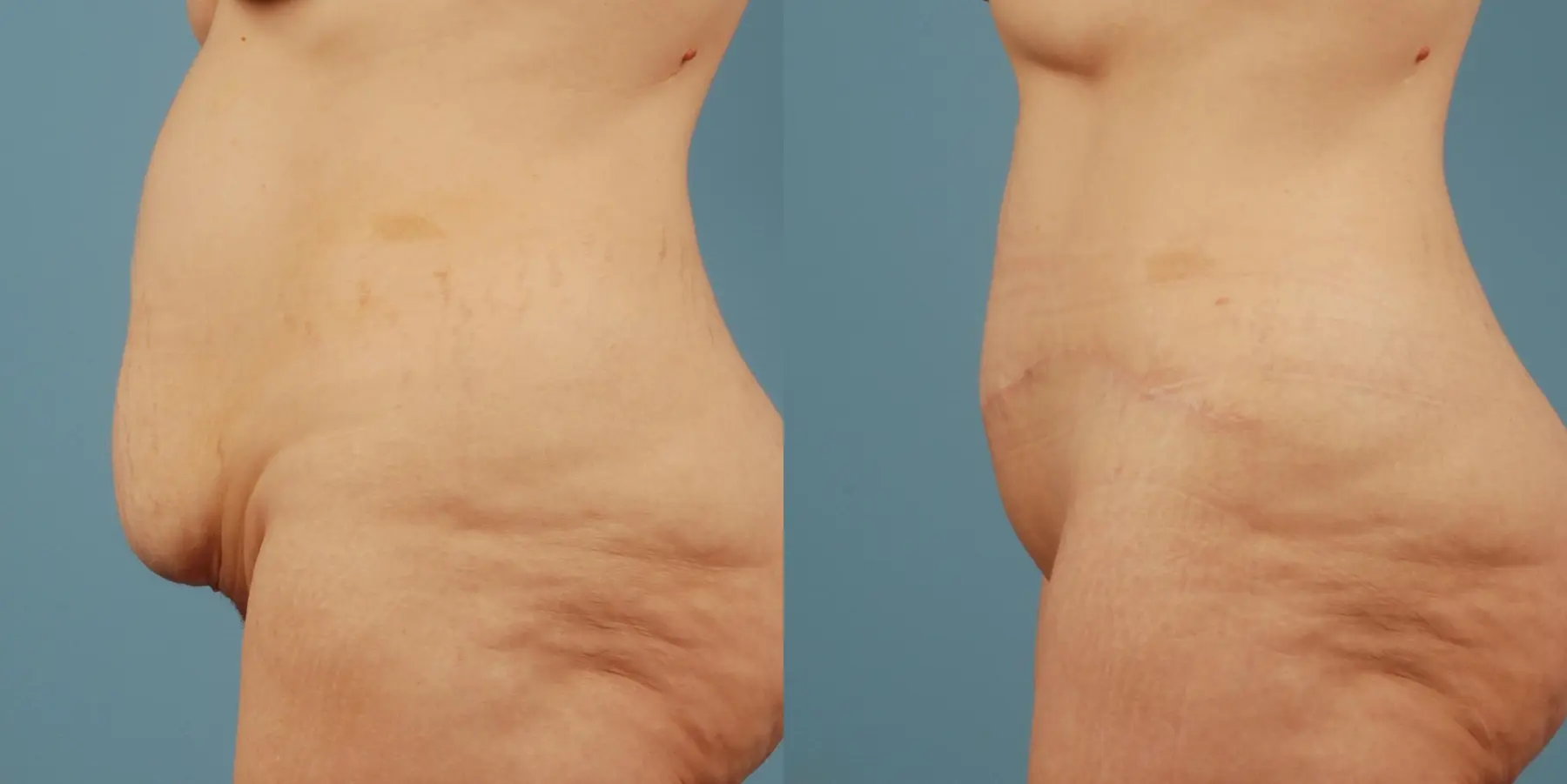 Tummy Tuck: Patient 20 - Before and After 6