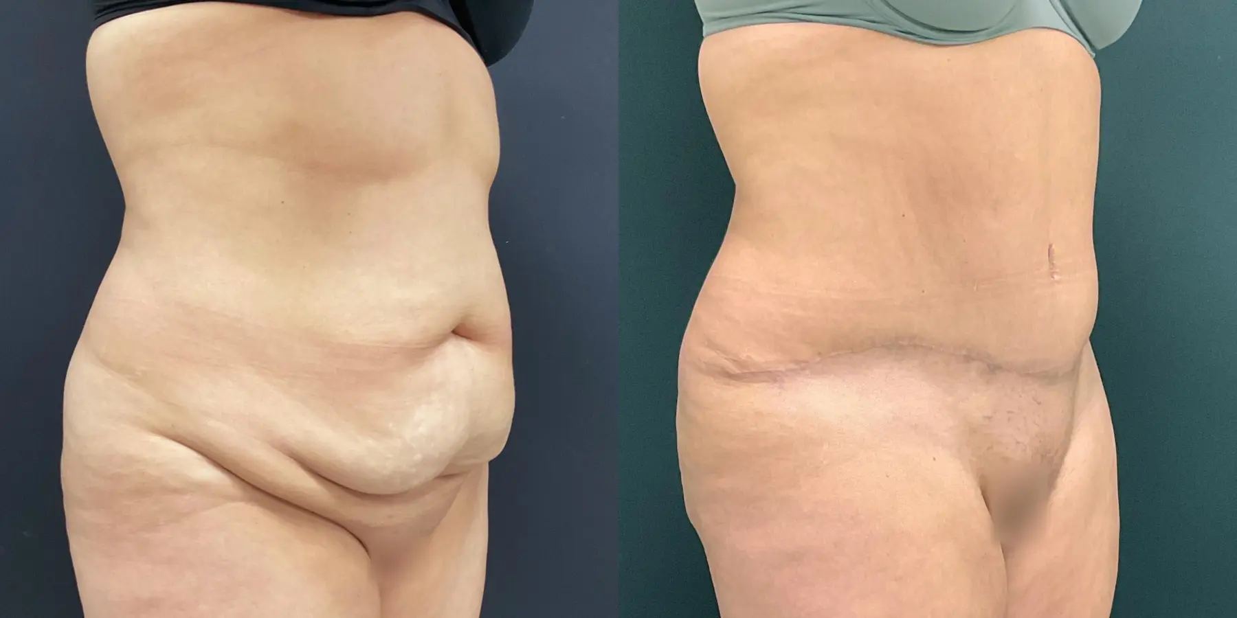 Tummy Tuck: Patient 12 - Before and After 3