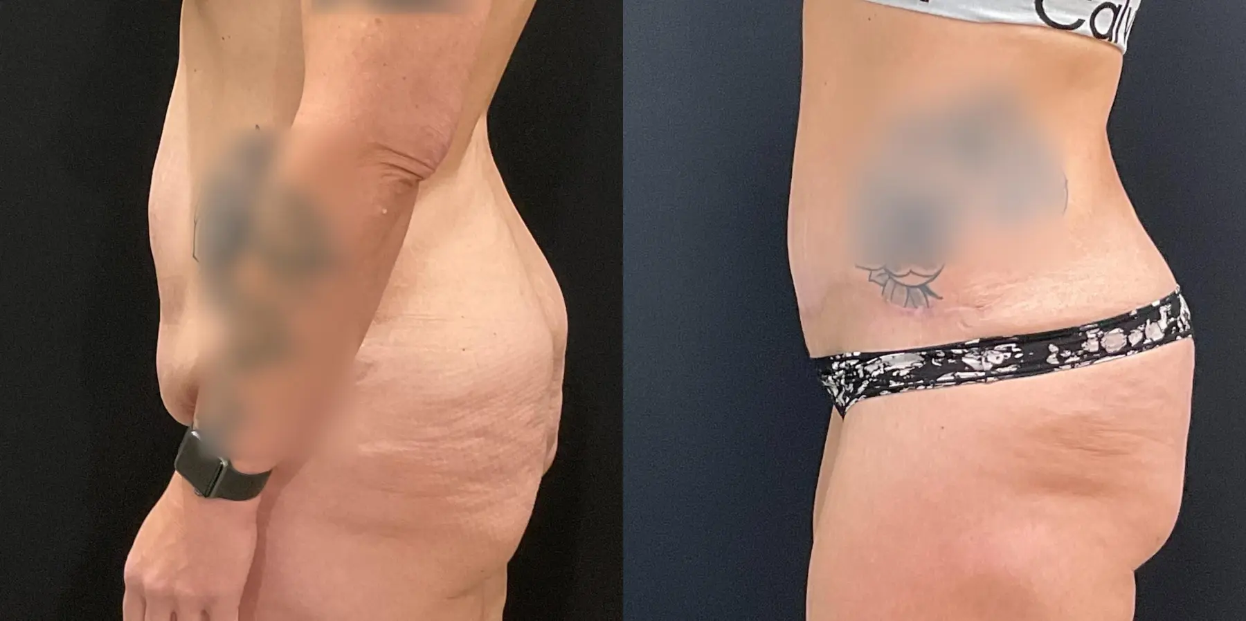 Tummy Tuck: Patient 15 - Before and After 4