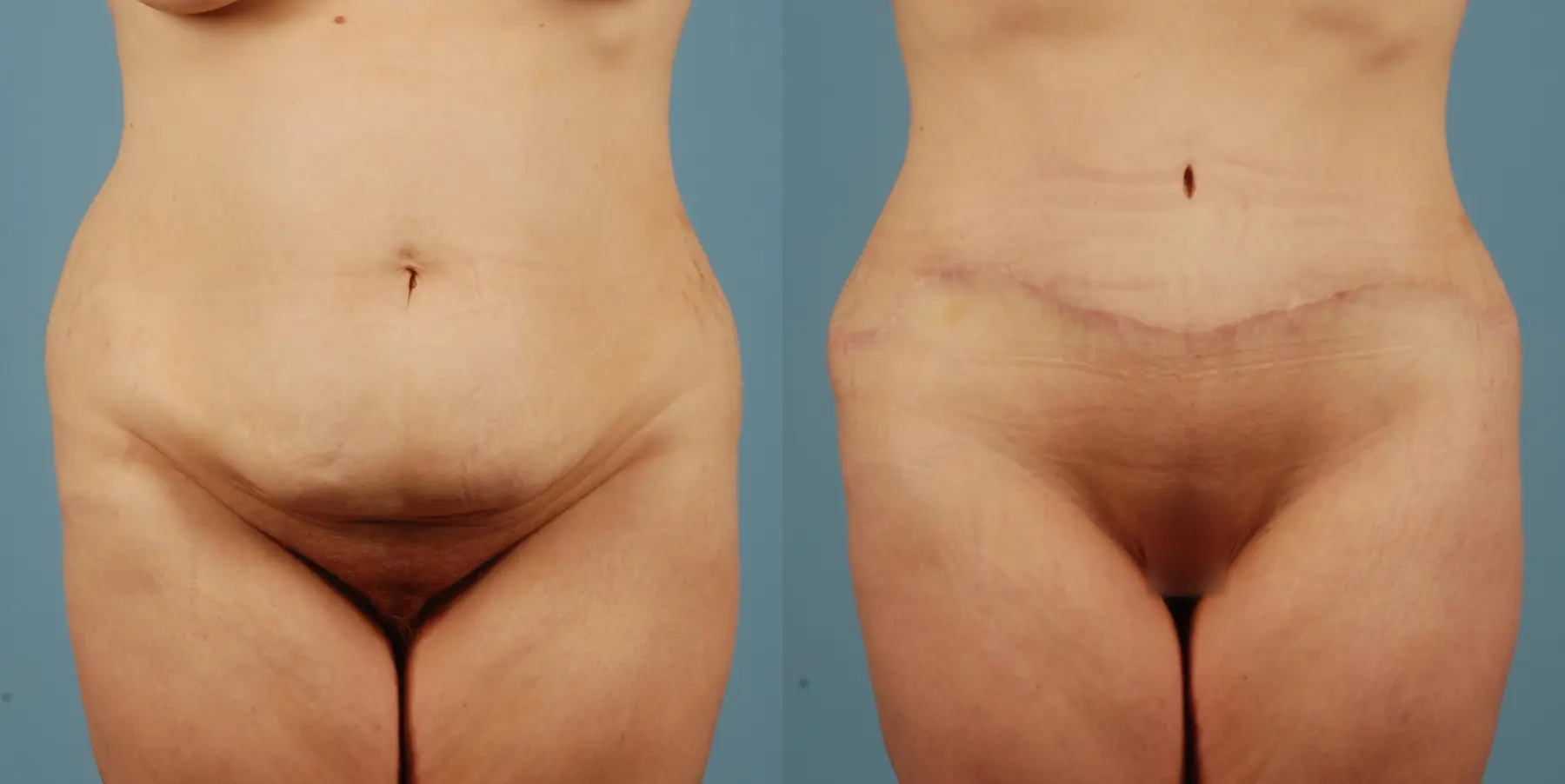 Tummy Tuck: Patient 20 - Before and After  