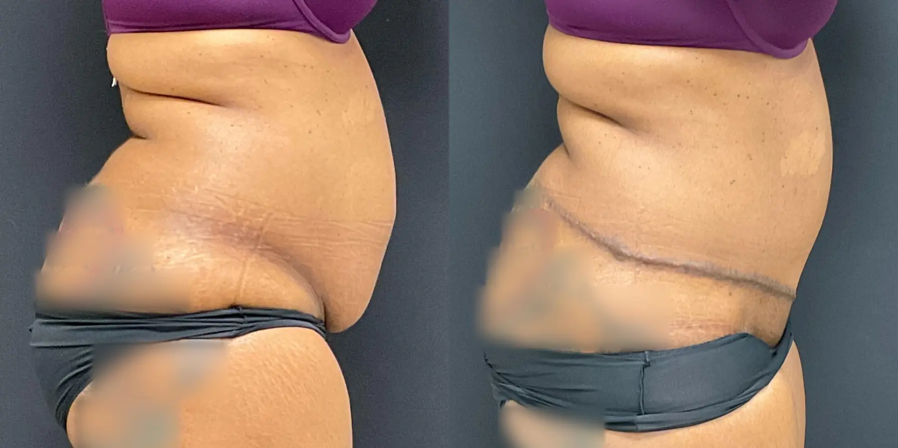 Tummy Tuck: Patient 5 - Before and After 5