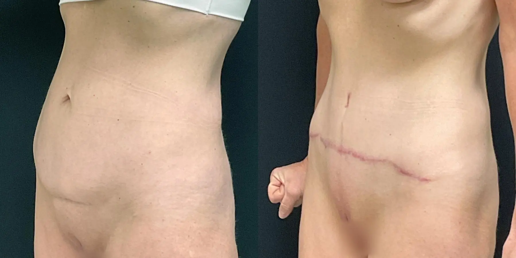 Tummy Tuck: Patient 13 - Before and After 2