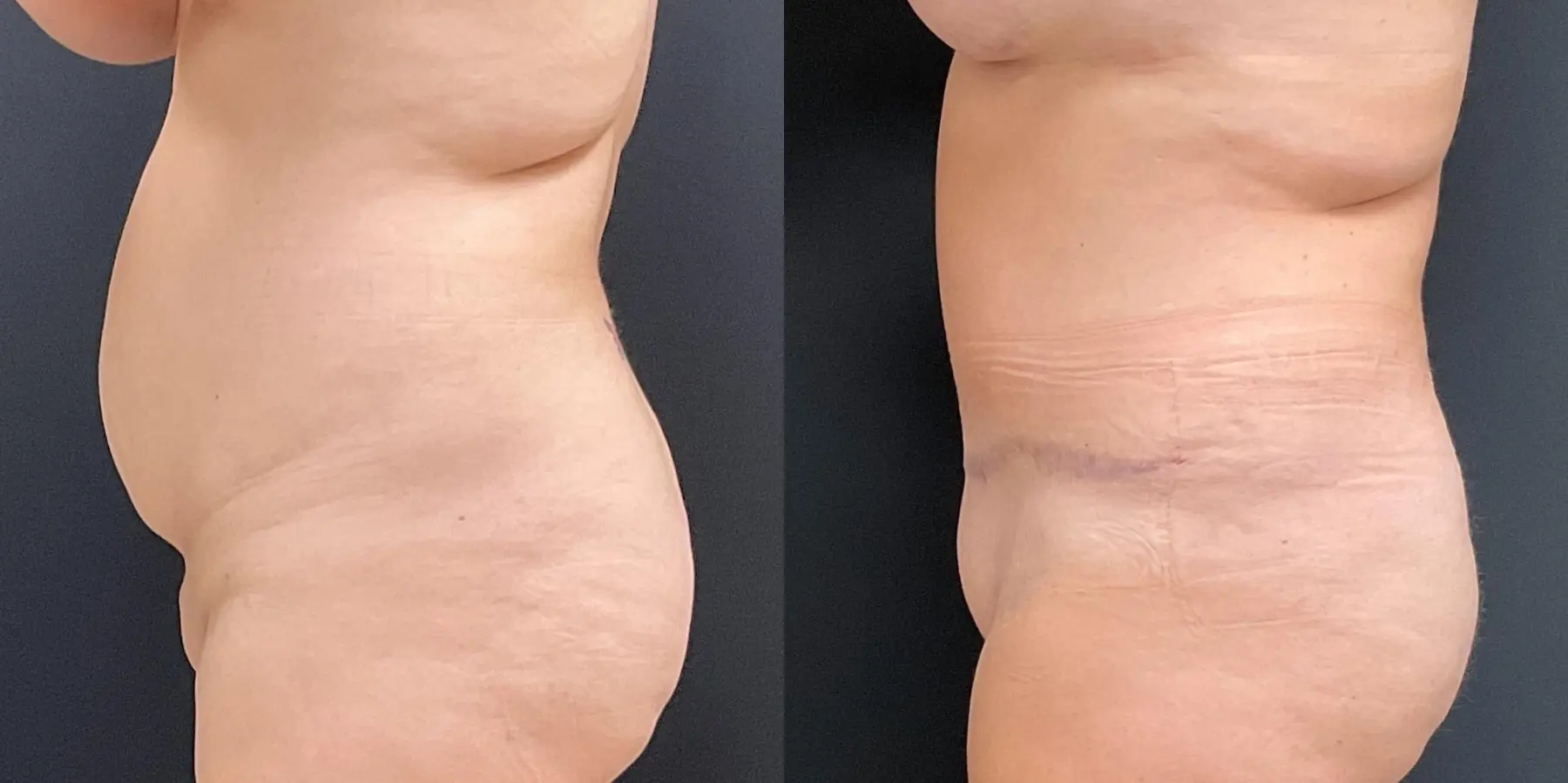 Tummy Tuck: Patient 16 - Before and After 4