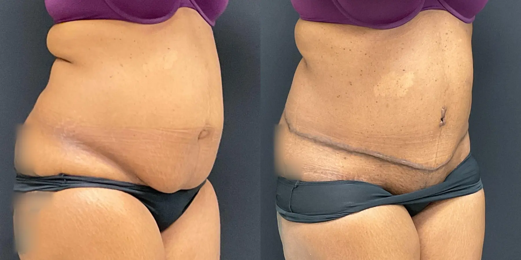 Tummy Tuck: Patient 14 - Before and After 4