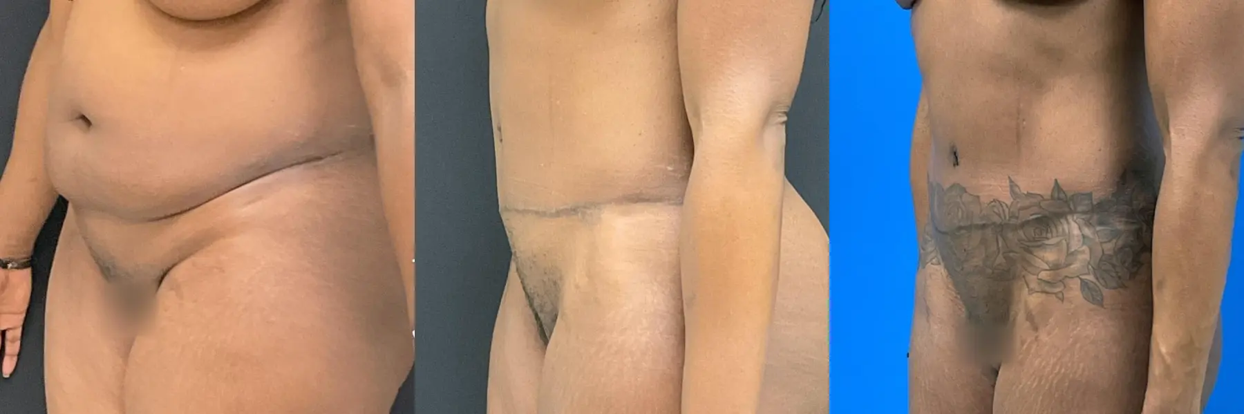 Tummy Tuck: Patient 10 - Before and After 2