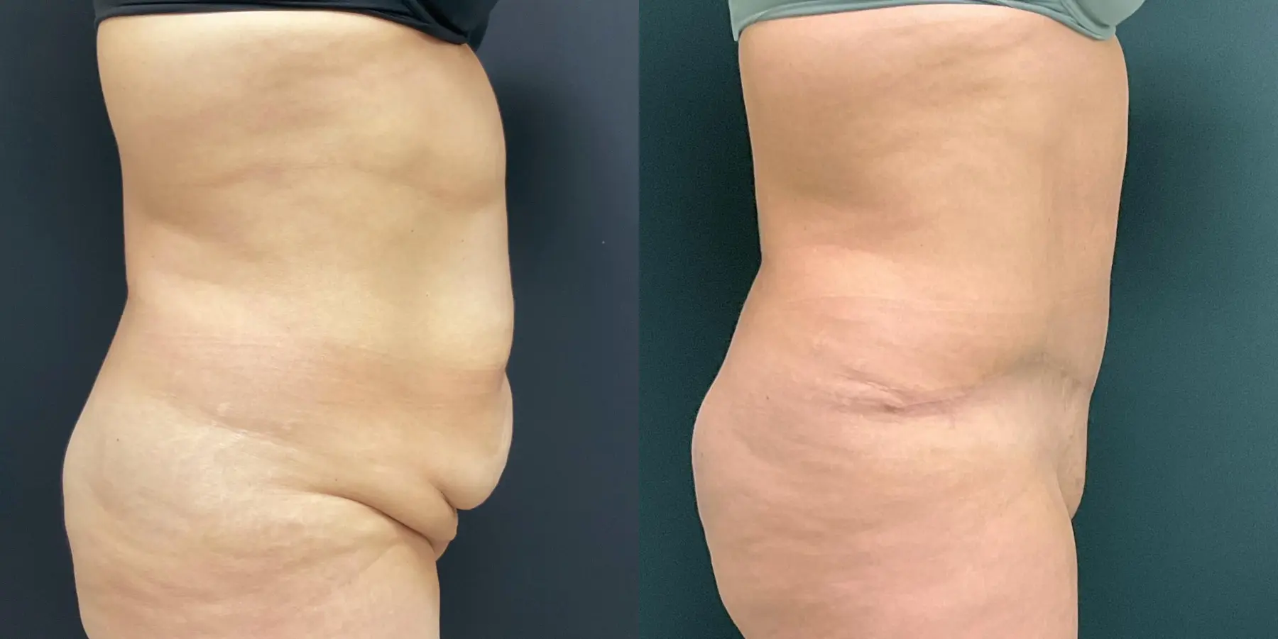 Tummy Tuck: Patient 12 - Before and After 5