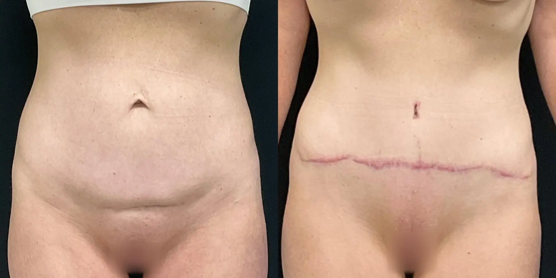Tummy Tuck: Patient 22 - Before and After  