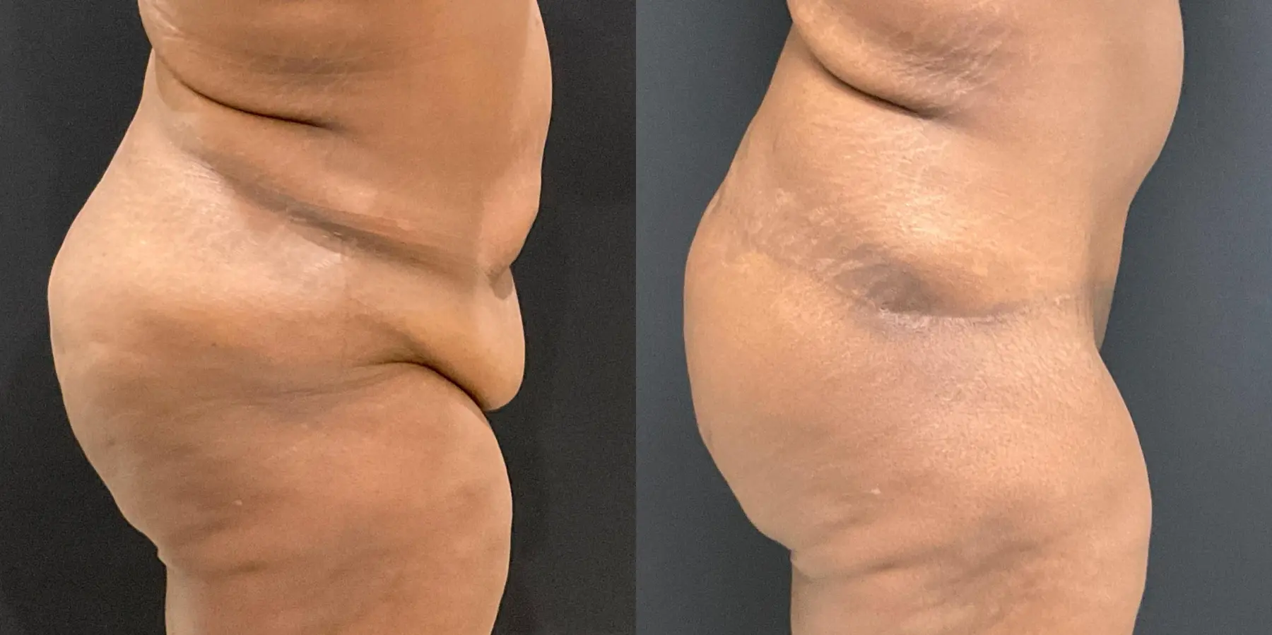 Tummy Tuck: Patient 3 - Before and After 4