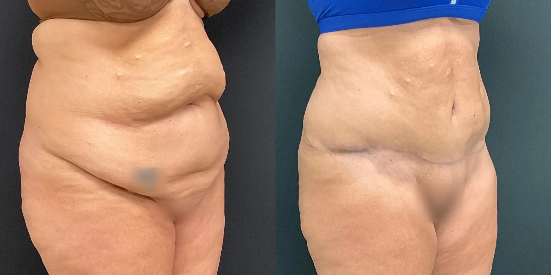 Tummy Tuck: Patient 8 - Before and After 3