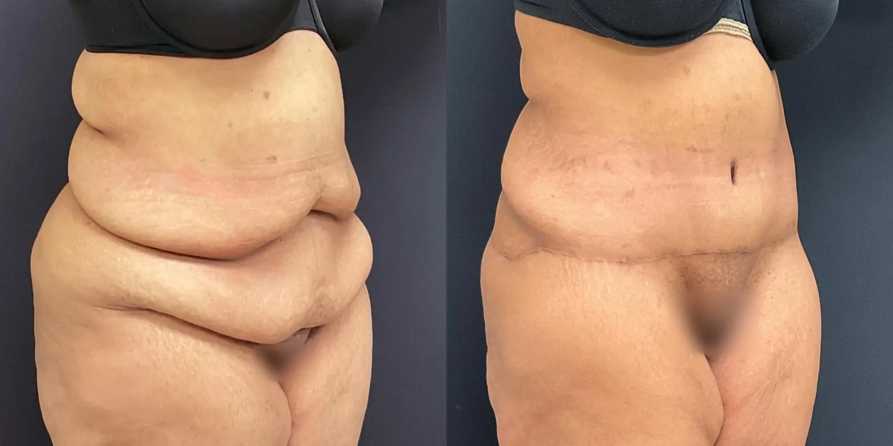 Tummy Tuck: Patient 1 - Before and After 3