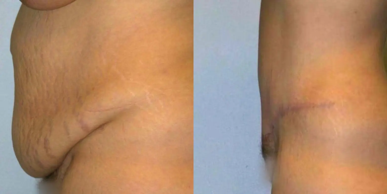 Tummy Tuck: Patient 15 - Before and After 2