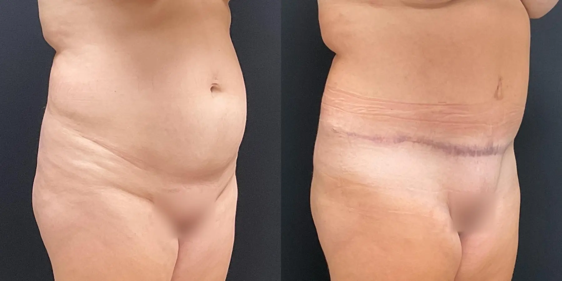 Tummy Tuck: Patient 16 - Before and After 3