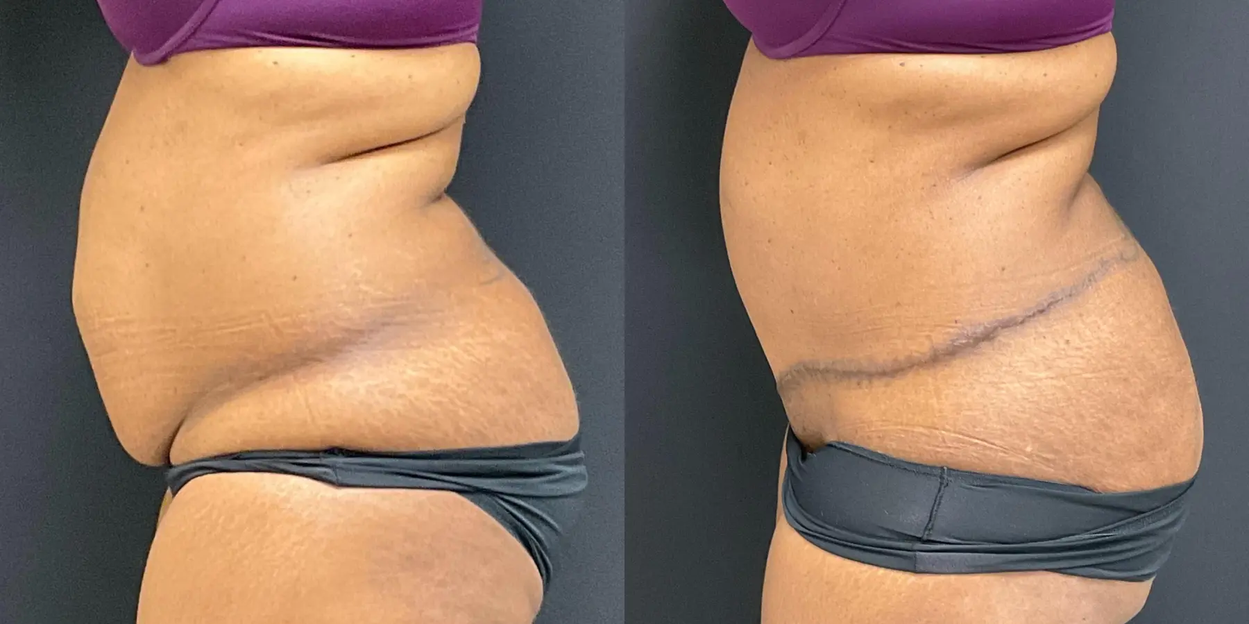 Tummy Tuck: Patient 14 - Before and After 3