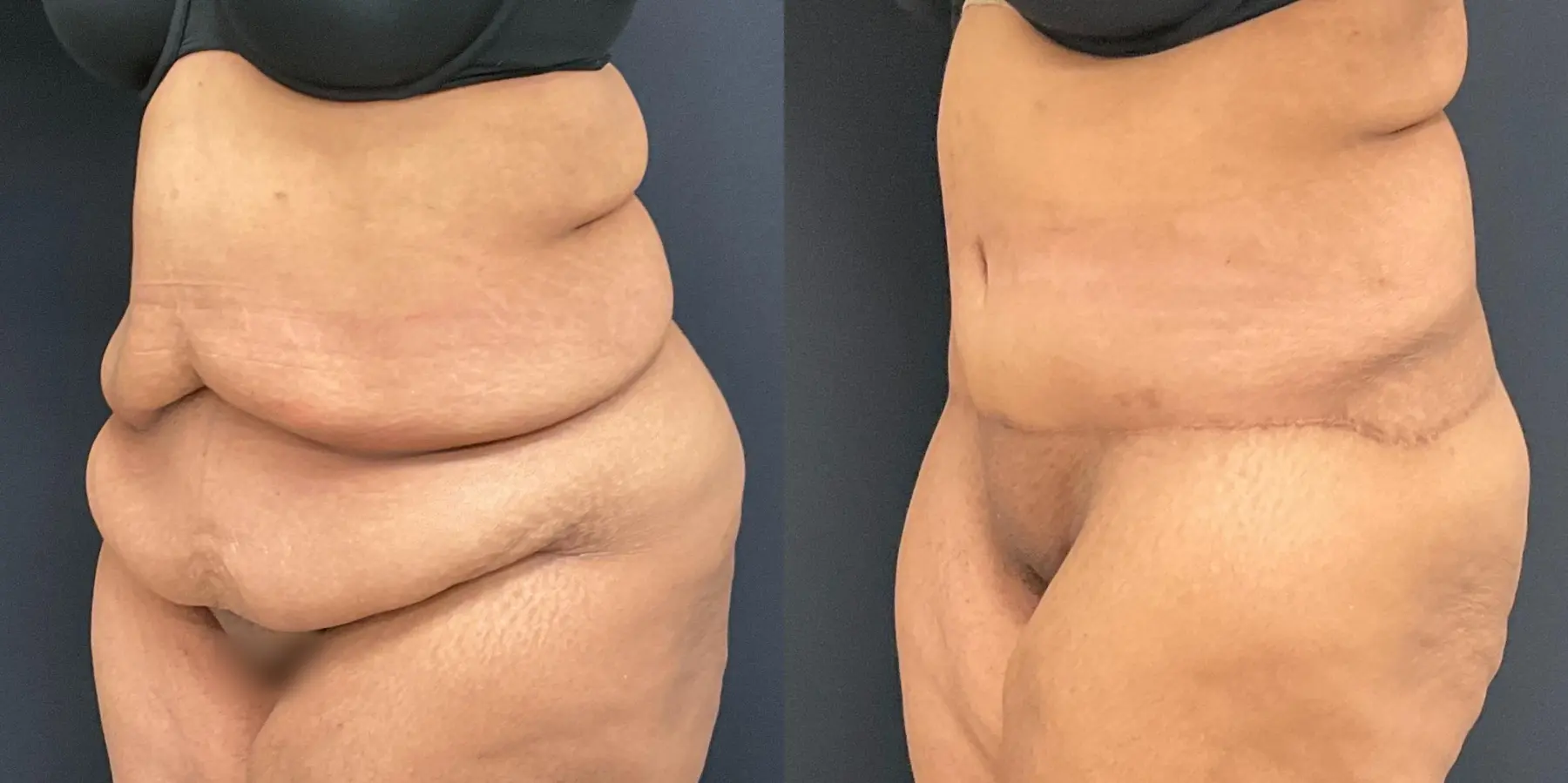 Tummy Tuck: Patient 10 - Before and After 2